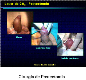 laser-urologia
