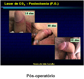 laser-urologia2