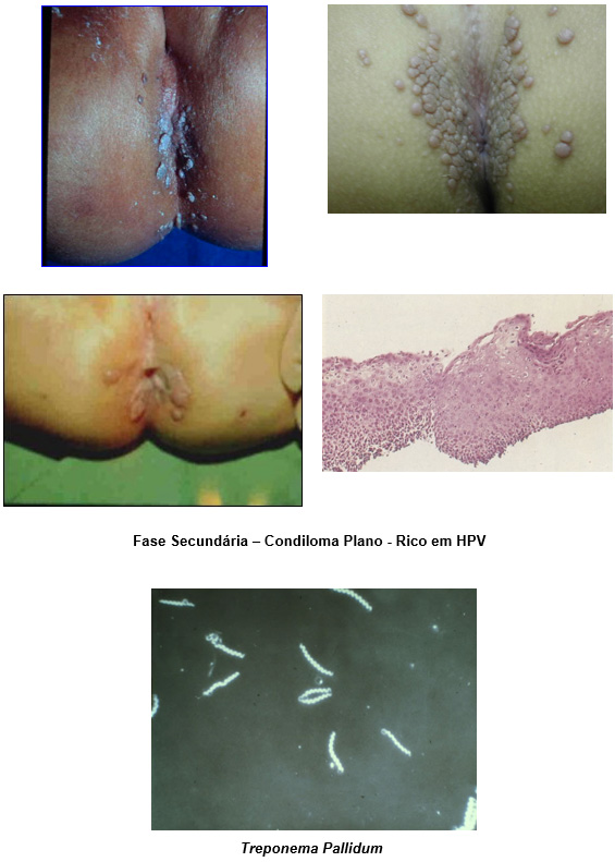 Manifestările cutanate ale infecţiei cu virusul papiloma uman